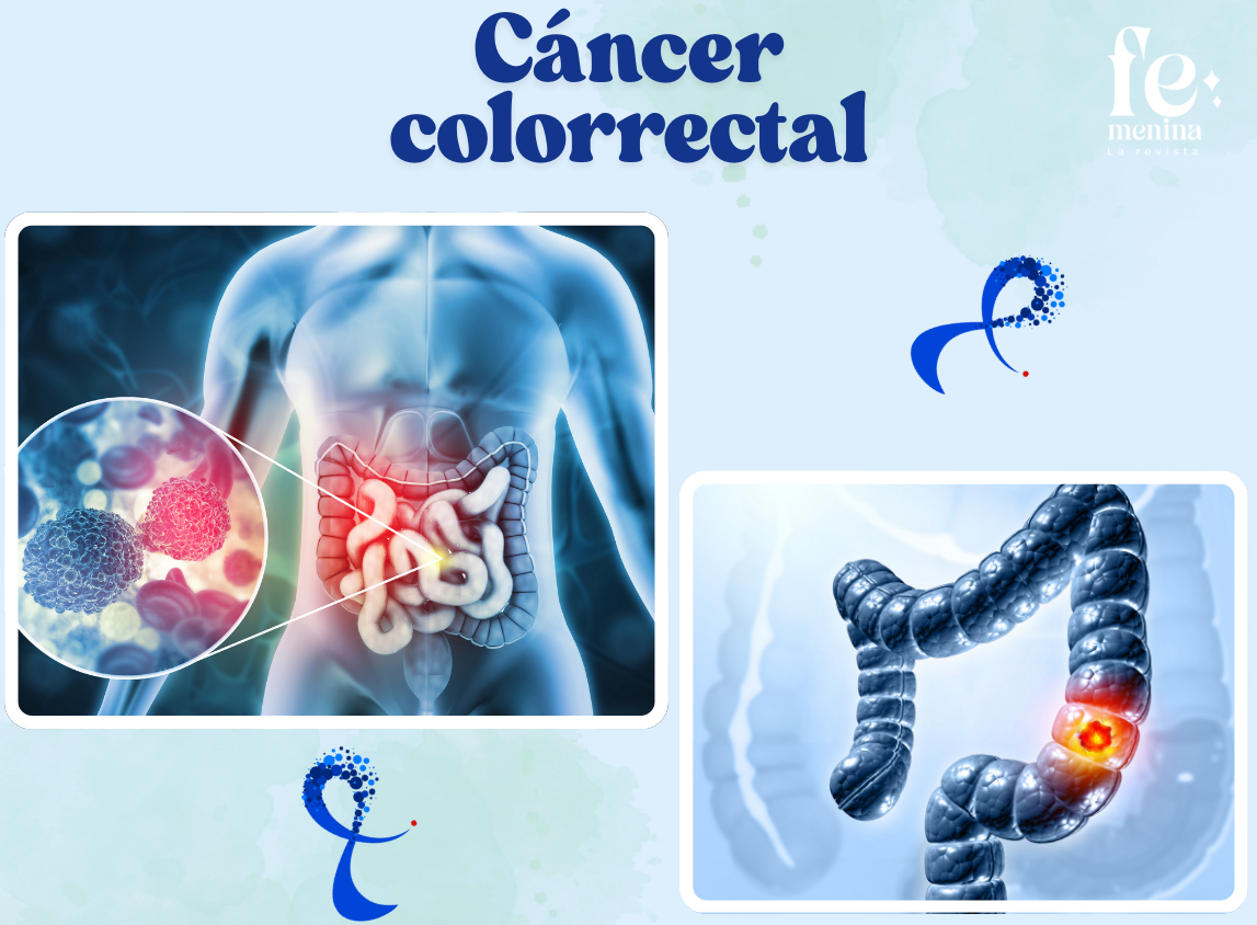 Cáncer colorrectal: atención ponga a cuatro  síntomas primordiales